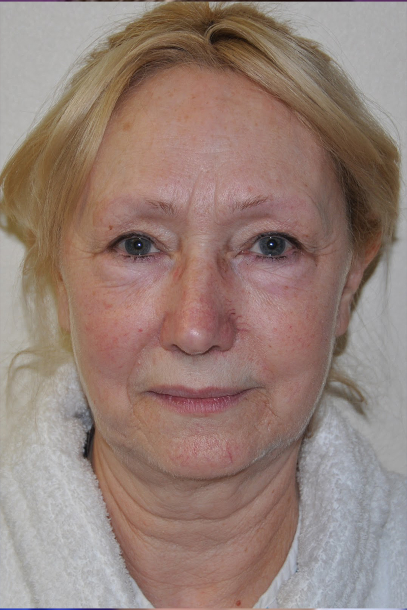 View 2 — before (pre-operative)